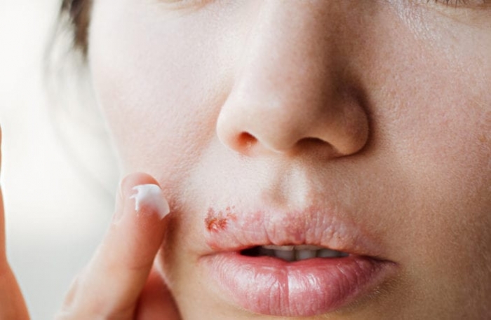 Herpes labial: o que é, sintomas, causas e tratamento