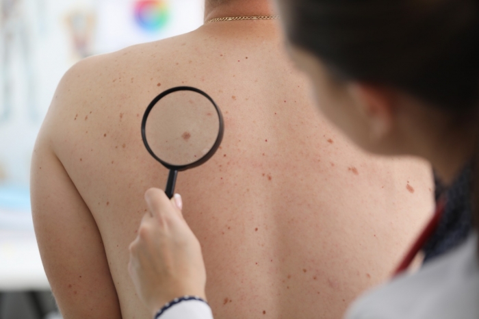 Dermatologista reforça importância do autoexame para prevenir câncer de pele