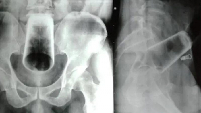 Homem passa por cirurgia para retirar copo de 12cm alojado no ânus 