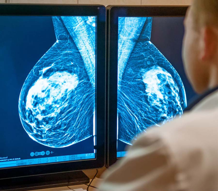 Dia Nacional da Mamografia é celebrado no dia 5 e alerta sobre a realização periódica do exame  